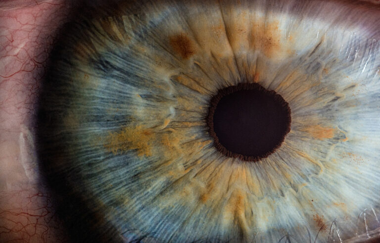 An eye on melanoma